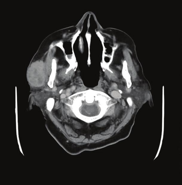 2 Case Reports in Otolaryngology Figure 1: Lobular-contoured solid mass in the anterior lobe of the right parotid