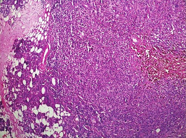 Normal parotid tissue in the left (residue) (100x HE). The melanin-rich tumor (400x HE).