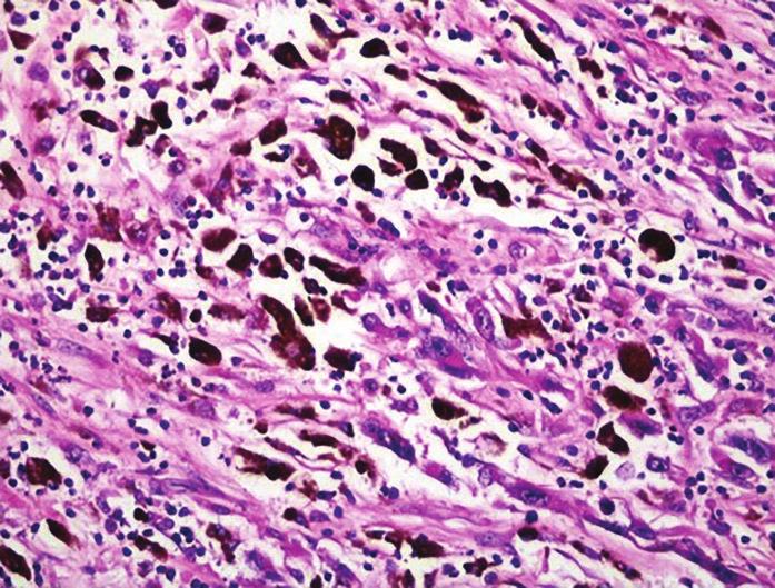 Asterisk: salivary duct, negative staining for HMB-45.