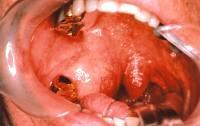 Dysphagia Change of voice Nasal obstruction