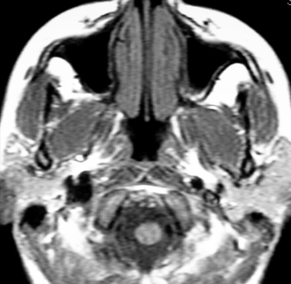 Nasopharyngeal Carcinoma Early diagnosis Best on MRI Obliteration of the fat strip between the tensor and levator veli