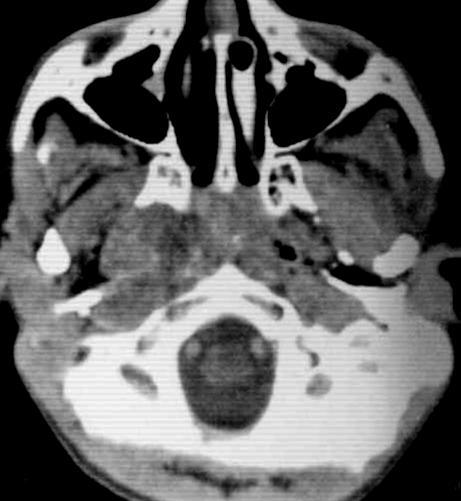 Rhabdomyosarco ma The most common sarcoma of the head and neck Arise from the primitive mesenchymal cells 70% arise before the age of 12 years Orbit > nasopharynx >temporal bone >