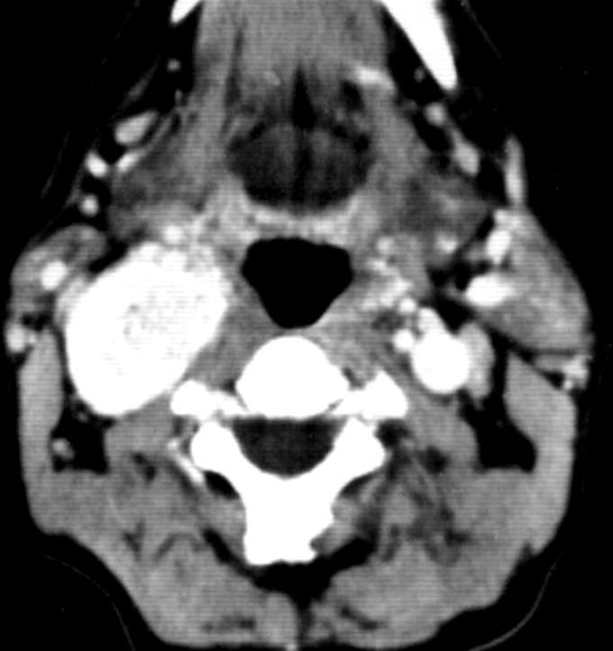 Glomus tumor Common