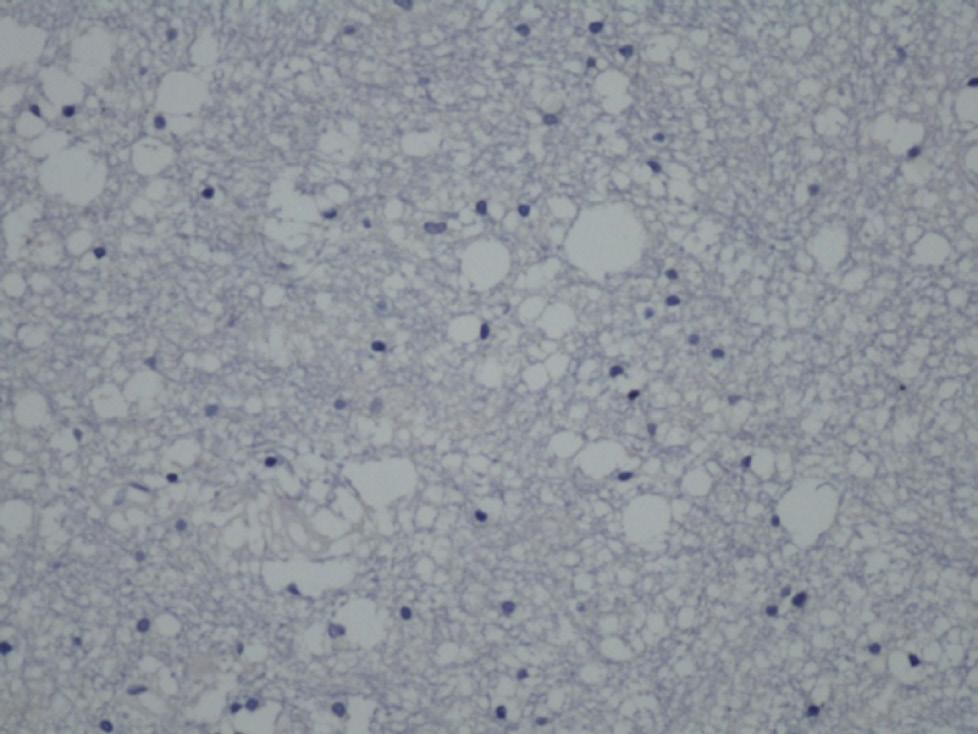 18 CDC25B, Ki-67 and p53 expressions in astrocytomas Figure 1. No CDC25B expression in this PA case (CSI %; CDC25B immunohistochemistry x2). Figure 2.
