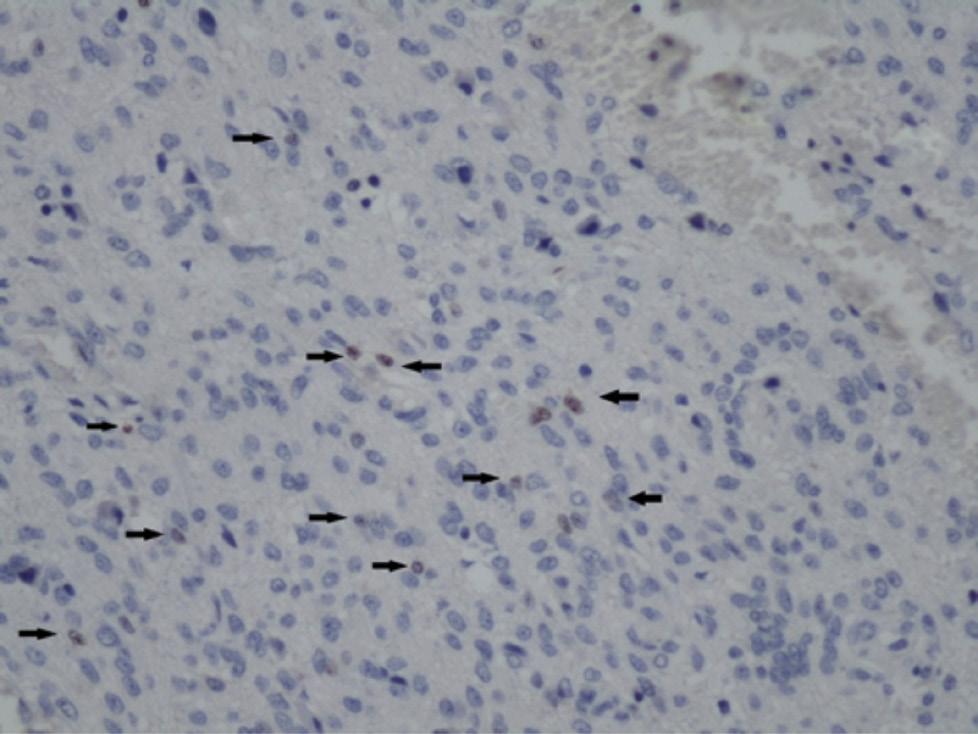 5%; CDC25B immunohistochemistry x2). data, the increase in CSI in parallel with the increase in WHO grade was statistically significant (p=.1).