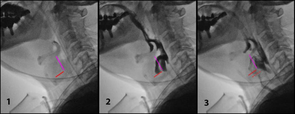 Fig. 7: Aspiration during swallow (static). The contrast agent enters the laryngeal inlet but stops at the level of the closed glottis (2). So far, only a penetration occured.