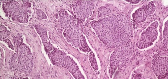 2 (a) Figure 1: Lobules and cords of aggressive digital papillary adenocarcinoma (H & E, original magnification 100x).