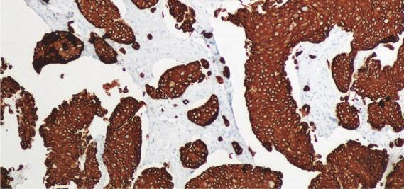 The histopathological differential diagnosis included a primary sweat gland carcinoma (aggressive digital papillary
