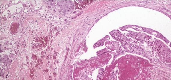 histologic parameters have been shown to be poor predictors of
