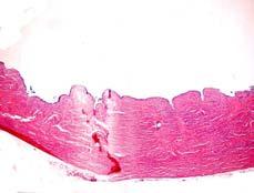 Grade Micropapillary Serous Carcinoma APST