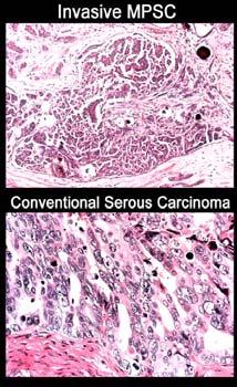 Low-grade pathway Dual Pathways of Serous Carcinogenesis Early Events