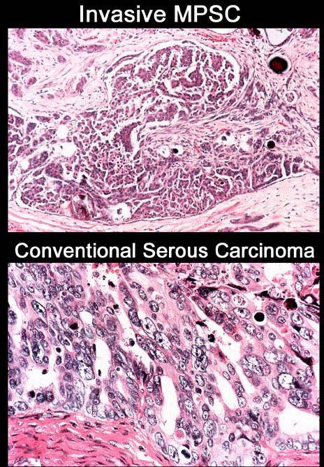 High-grade serous carcinoma Borderline Low-grade carcinoma