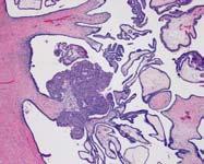 distinct types Low-grade micropapillary serous carcinoma High-grade
