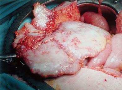 ovarian carcinomas are small, even when