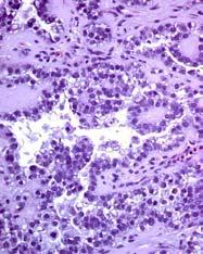 Clear Cell Carcinoma By definition a high grade carcinoma