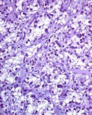Clear Cell Carcinoma Clear Cell Carcinoma A high incidence