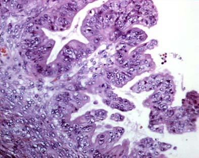 Mucinous Carcinoma Prognosis Intraepithelial mucinous carcinoma Risk of recurrence