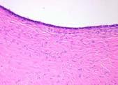 Familial Serous carcinoma: pathogenesis Inclusion cyst BRCA-1 mutation