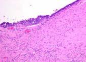 tumor (BT) High grade serous carcinoma: pathogenesis TP53 mutation High