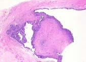Serous carcinoma: differential diagnosis Glandular, cribriform,