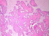 Clear cells, signet ring cells: Clear cell, endometrioid, mucinous Ovarian