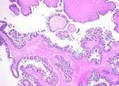 stage III-IV ovarian carcinoma Low stage serous carcinomas are rare ~25% of