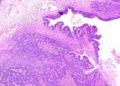 Negative p16 (Endocervical ddx) Negative ER (Endometrioid ddx) Retained SMAD4/DPC4 (Pancreatic ddx) Negative mesothelin and fascin (Pancreatic ddx)
