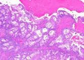 Mucinous tumors: borderline versus carcinoma Expansile invasion Large cribriform glands Extensive gland fusion Complex papillary architecture
