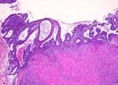 Endometrioid tumors: genotype CTNNB-1 ( -catenin) PTEN Microsatellite instability (MSI)