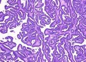 pathogenesis Endometrioid tumors: borderline versus carcinoma Expansile invasion Large
