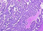 2 endometrioid carcinomas (8 IA, 5 IC); median F/U 81 mos: 9 expansile (9/9 NED) 4