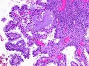pathogenesis Endometriosis Atypical endometriosis or Endometrioid carcinoma (Clear cell borderline tumor) Clear cell