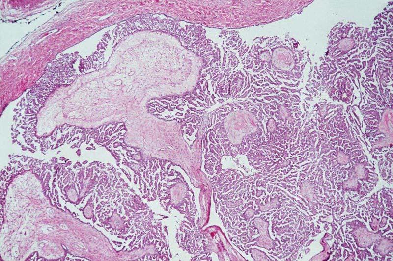 pathogenesis of ovarian carcinomas come from studies of serous and
