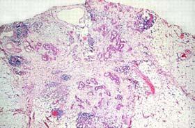 I carcinoma which is >90% The Controversy There is no significant difference in the