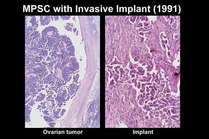 What are Invasive Implants?