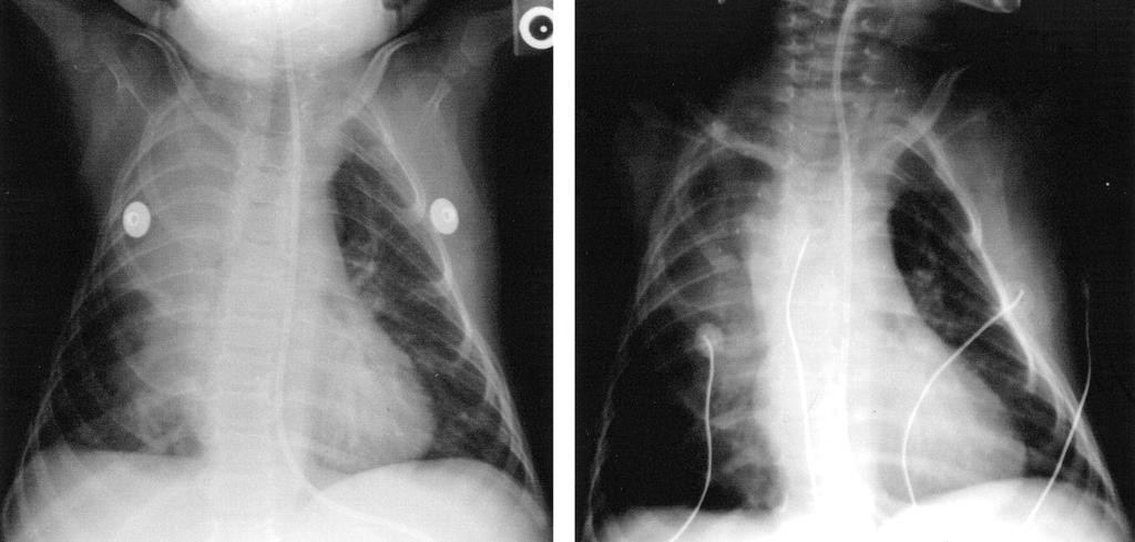 Chest radiograph of