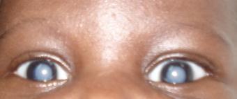 Major causes of Childhood Blindness at Korle-Bu A B C D E F A- Bilateral Congenital Cataract