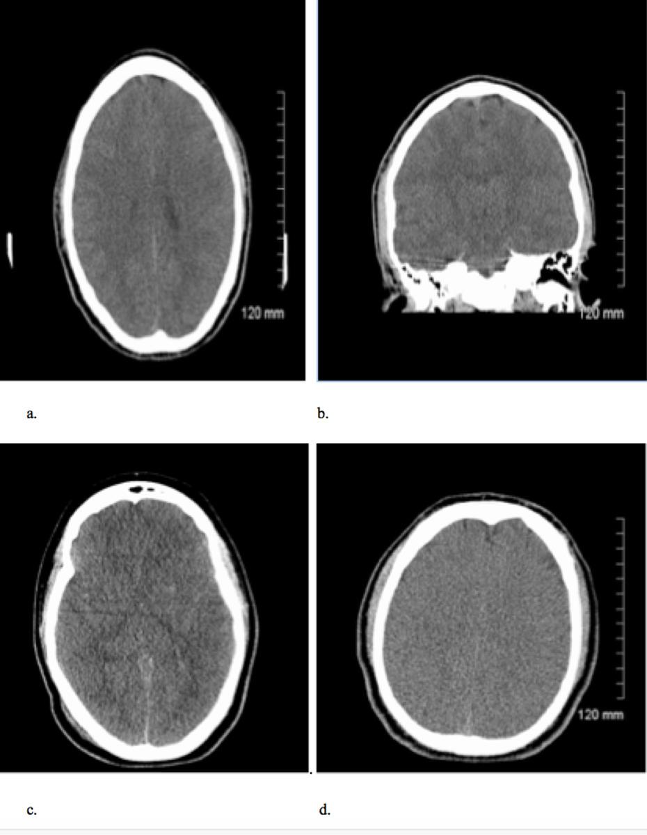 Fig. 1: Axial (a) and coronal (b) views of non - contrast enhanced CT brain in patient admitted unconscious post cocaine overdose.