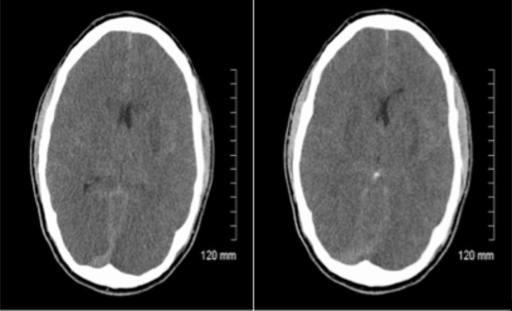 patient admitted with multiorgan trauma (c) demonstrating brain edema and slightly more pronounced white/ grey matter differentiation.