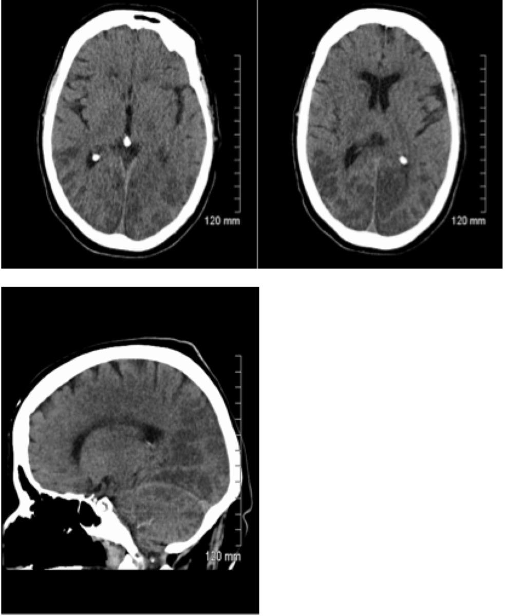 Fig. 3: Axial and saggital views of non - contrast enhanced CT brain in elderly female with background ischemic heart disease post fall on ward and unconscious since.