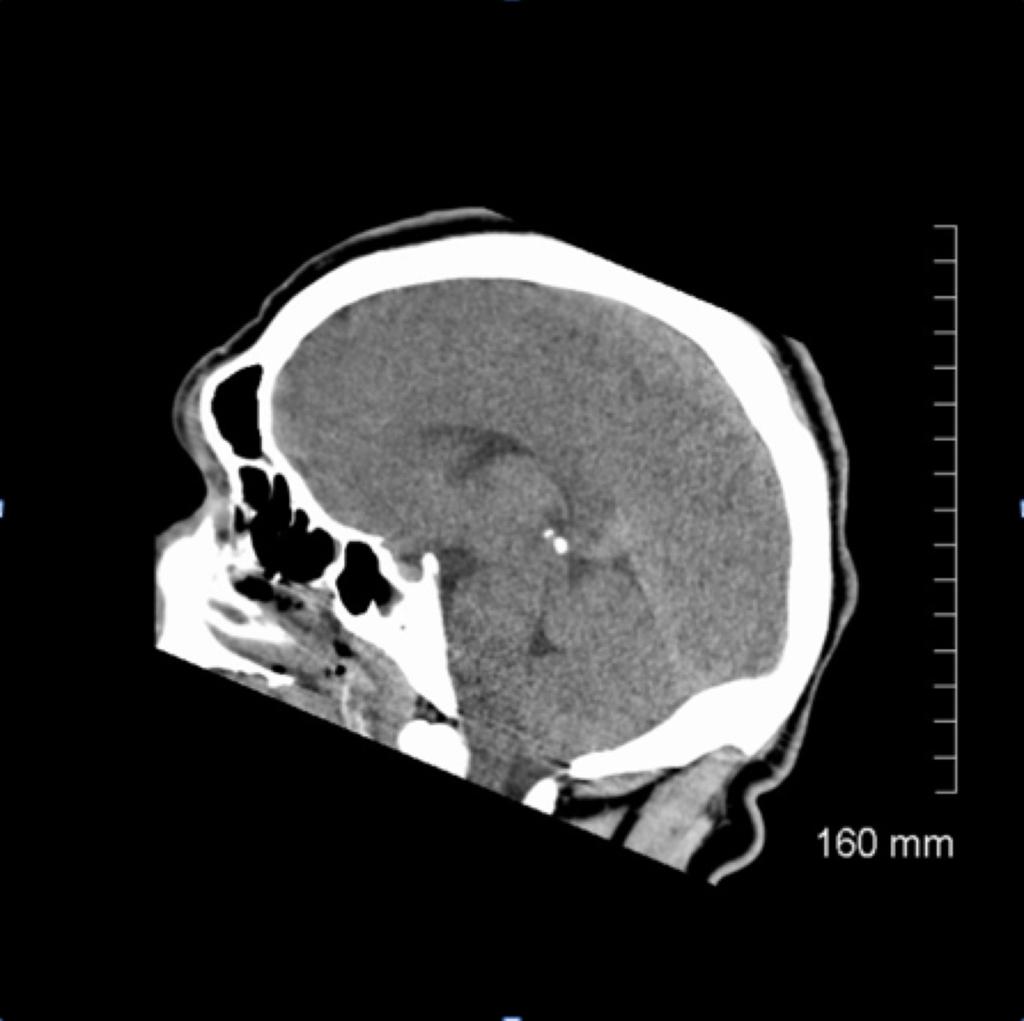 Fig. 5: Saggital view of non - contrast CT brain of young patient admitted post prolonged cardiac arrest of unknown cause.