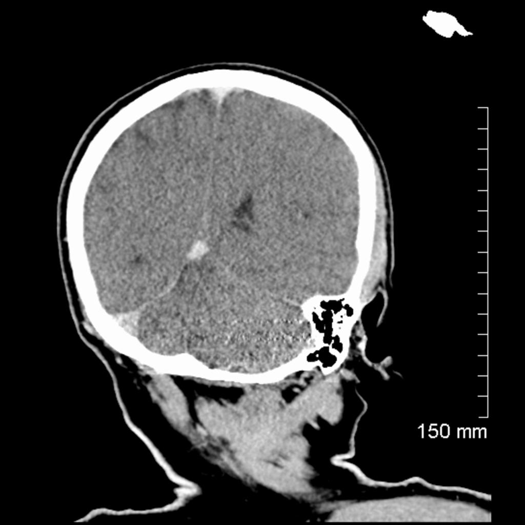 Fig. 8: Non - contrast enhanced CT brain in patient with multi organ trauma.