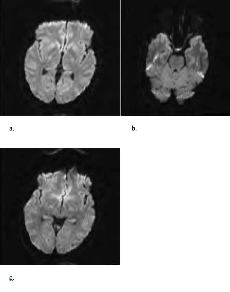 Fig. 9: Axial images from DWI in elderly patient with known poorly controlled arrythmia admitted to Intensive Care Unit post short