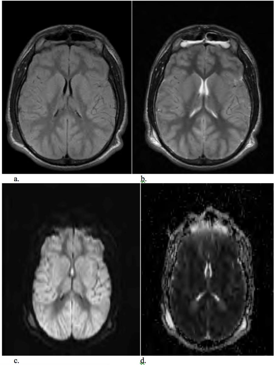 Fig. 10: Axial MRI FLAIR (a), T2 (b), DWI B1000 (c), and ADC (d) images in patient found