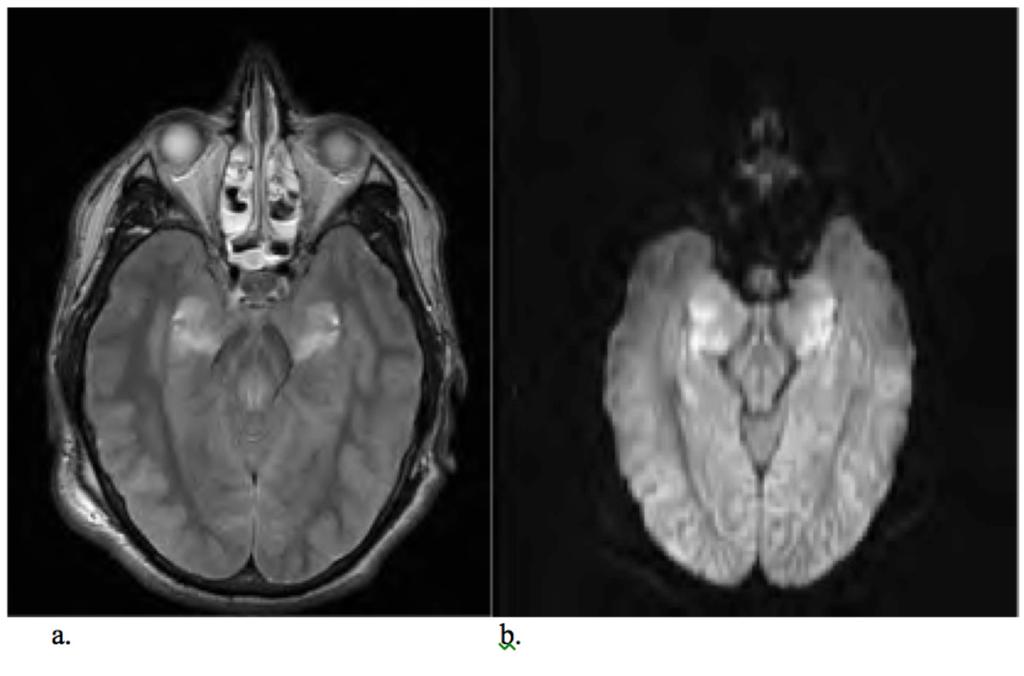 Fig. 11: Axial MRI FLAIR (a), T2 (b), DWI B1000 (c), and coronal T2 (d) images in patient with prolonged seizure activity demonstrating T2/ FLAIR cortical hyper intensity and oedema involving in