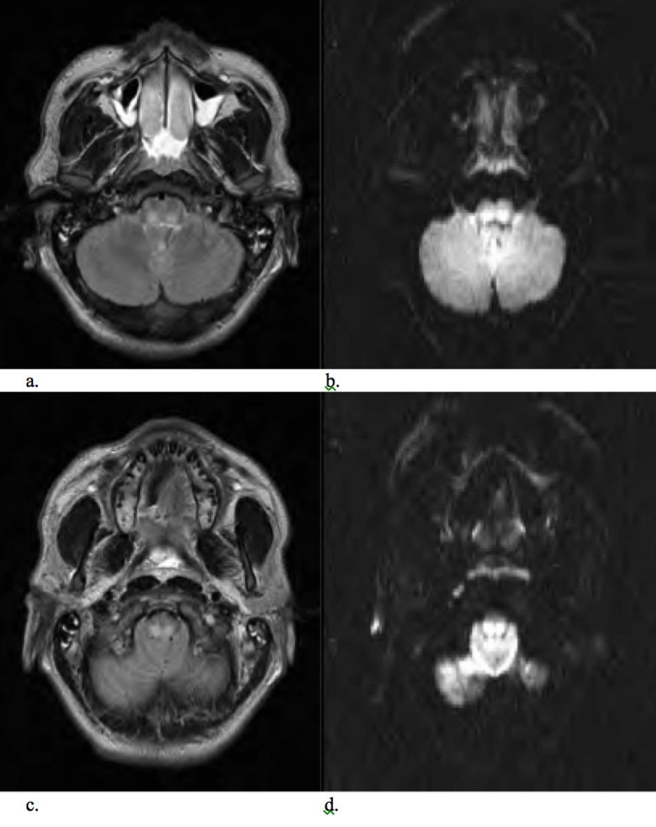 Fig. 13: Axial MRI T2 (a,c) and DWI B1000 (b,d) images in patient found