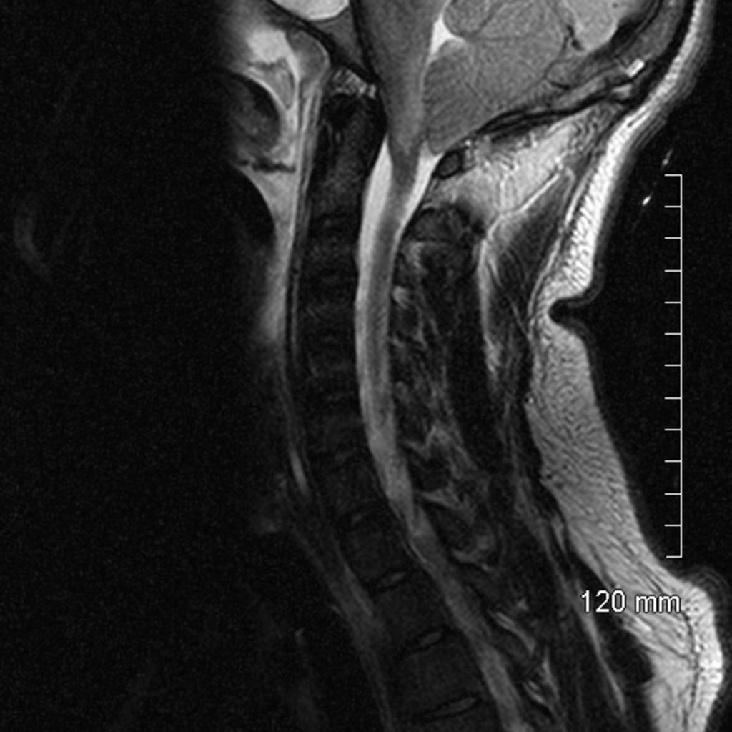 Fig. 14: Sagittal view of T2 weighted MRI on patient found hanging