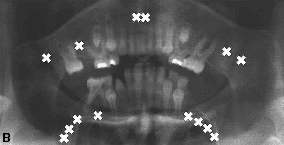 (B) Panoramic radiograph of individual IV-5 depicts typical pattern of congenitally missing teeth in this family.