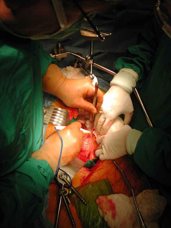 Elective open repair AAA Major surgical procedure