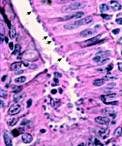 Histologic section of small intestine of patient suffering from